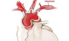 Tìm hiểu triệu chứng và cách điều trị bệnh viêm động mạch Takayasu