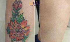 Địa chỉ xóa xăm uy tín ở Hà Nội được cấp phép bởi Sở y tế 