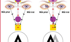 Bệnh song thị: Nguyên nhân, triệu chứng và hướng chữa trị