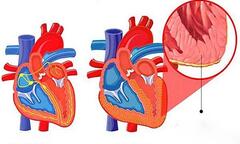 Cùng Bác sĩ Dược Sài Gòn tìm hiểu về viêm cơ tim do virus