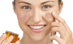 Bạn có thuộc đối tượng dễ bị nám, tàn nhang tấn công?