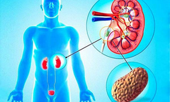 Những lưu ý quan trọng về bệnh sỏi tiết niệu