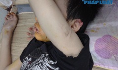 Bé trai 14 tuổi bị hành hung đã qua cơn nguy kịch