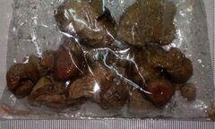 Gắp thành công viên sỏi “khủng” trong thận nữ bệnh nhân