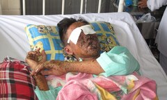 Lò bánh tét phát nổ, nam thanh niên vỡ nát hai mắt