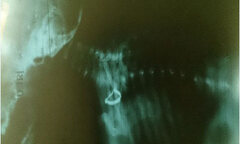 Gắp thành công chiếc khuyên tai trong thực quản bé 5 tháng tuổi