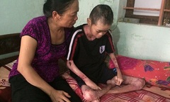 Mang căn bệnh quái ác, chàng trai 20 tuổi bong da, tróc thịt từng ngày