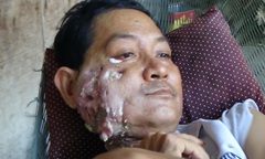 Vợ đau khổ nhìn chồng rơi từng miếng thịt nằm nhà chờ chết