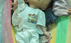 Khốn khổ cuộc sống của bé 14 tháng tuổi có đầu to gấp bốn lần cơ thể