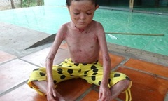 Xót xa bé 11 tuổi mắc bệnh  "lột da ếch ", mẹ tâm thần, cha bỏ đi biệt tích