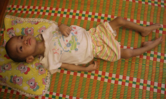 Mong manh sự sống của bé 2 tuổi với 3 lần mổ não