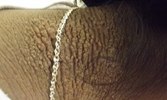 Ước mơ khỏi bệnh để có bạn chơi cùng của cô bé 'da trâu'