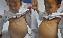 Bé 4 tuổi đáng thương với bụng phình to từng ngày