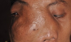 Chàng trai đáng thương với ước mơ được cắt bỏ khối u khổng lồ trên mặt