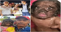 Bé gái 2 tuổi mắc  "hội chứng người sói " bỗng trở nên nổi tiếng và được mệnh danh là “đứa trẻ đến từ thiên đường”