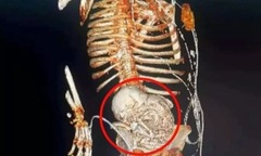 Cụ bà U80 qua đời sau khi loại bỏ bào thai bị vôi hóa trong cơ thể suốt 56 năm