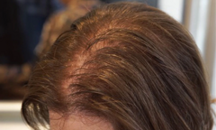 Rụng tóc nhiều – Tình trạng đáng báo động của giới trẻ ngày nay