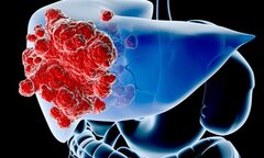 Ung thư gan và điều cần biết