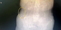 Video: Phát hiện  "vật thể lạ " khoảng 5cm trong bụng người phụ nữ
