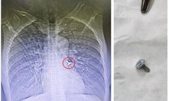 Hắt hơi khi đang ngậm đinh, người đàn ông nhập viện cấp cứu