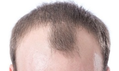 Quý ông hói đầu có phải do yếu sinh lý?
