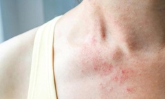 Bảo Thanh Đường địa chỉ uy tín chữa tận gốc bệnh chàm (eczema)