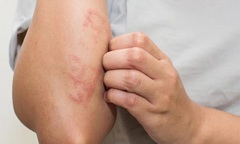 Điều trị bệnh chàm nhanh nhất tại Bảo Thanh Đường