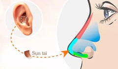 Nâng mũi bằng sụn tai là gì?