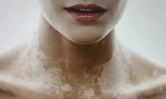 Đông y Bảo Thanh Đường khắc tinh của bệnh bạch biến 