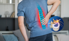 4 giai đoạn tiến triển của thoát vị đĩa đệm lưng và giải pháp cải thiện hiệu quả từ Cốt Thoái Vương