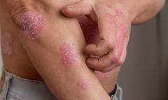 Chữa bệnh chàm á sừng bằng phương thuốc quý tại Bảo Thanh Đường