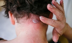 Tôi đã chữa khỏi bệnh vảy nến ở Bảo Thanh Đường