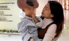 Tiết lộ lý do xót xa khiến cậu bé 3 tuổi bị gắn biệt danh  "chuột Mickey "