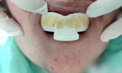 Cô gái 24 tuổi suýt chết vì tự làm hàm duy trì chỉnh nha bằng... thạch cao mua trên mạng!