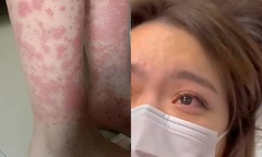 Cô gái trẻ suy thận, cạo đầu sau hai năm nhuộm tóc liên tục
