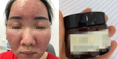 Dùng kem chống nắng xách tay không rõ nguồn gốc, giá bình dân, nữ sinh cháy da, bỏng mặt