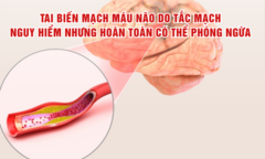 Tai biến mạch máu não do tắc mạch: Nguy hiểm nhưng hoàn toàn có thể phòng ngừa