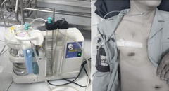 Tập đẩy tạ quá mức, nam thanh niên 25 tuổi tràn khí màng phổi nguy hiểm