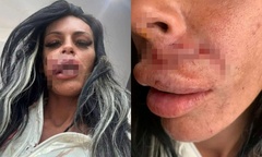 Người phụ nữ phải khâu 20 mũi trên mặt sau hành động vuốt ve chó lạ