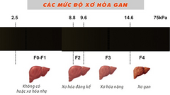 Từ xơ gan F4 đến hồi phục kỳ diệu nhờ Y học tái tạo: Hành trình sống lại của người phụ nữ 66 tuổi