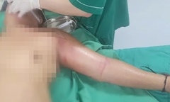 Tự tiêm mật gấu chữa đau ngực tại nhà, người đàn ông suýt mất mạng