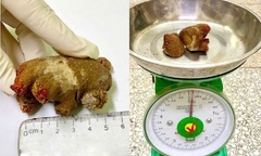 Viên sỏi san hô  "khổng lồ " ẩn mình 20 năm trong cơ thể người đàn ông