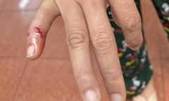 4 người ở Đắk Lắk bị chó lạ tấn công, 1 nạn nhân tử vong vì chủ quan