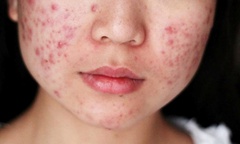 Dấu hiệu cảnh báo gan nhiễm mỡ  trên khuôn mặt