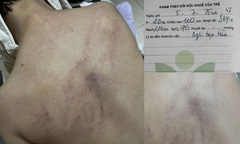 Vụ bé 4 tuổi nghi bị cô giáo bạo hành ở trường mầm non: Bộ Y tế vào cuộc, trưng cầu giám định