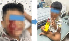 Đang chơi trong sân nhà, bé trai bị chó dữ tấn công, khâu 20 mũi