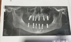 Cụ ông 77 tuổi tử vong sau cấy 6 implant và nhổ 12 răng