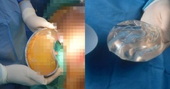 Bi hài hậu vận sau thẩm mỹ: Mẹ bầu  "khóc thét ", hoảng loạn sợ ảnh hưởng đến thai nhi khi túi độn ngực bị vỡ