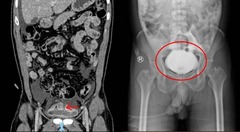 Nhịn tiểu lâu lúc uống bia, người đàn ông vỡ bàng quang sau khi té ngã