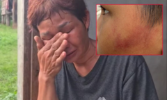 Bé trai 7 tuổi bị cô giáo dùng thước sắt đánh 14 lần vào mặt vì ăn một viên kẹo gây phẫn nộ